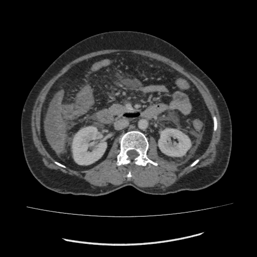Acute pancreatitis (Radiopaedia 80007-93285 Axial C+ portal venous phase 86).jpg