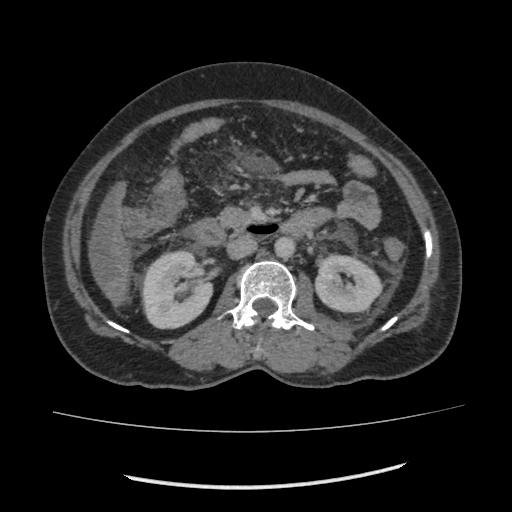 Acute pancreatitis (Radiopaedia 80007-93285 Axial C+ portal venous phase 87).jpg