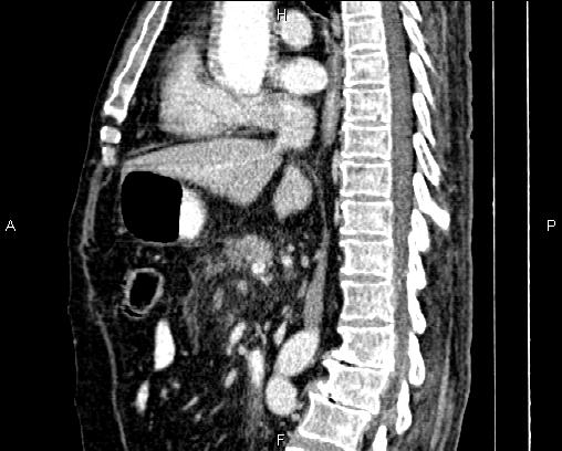 File:Acute pancreatitis (Radiopaedia 85146-100701 Sagittal C+ portal venous phase 47).jpg