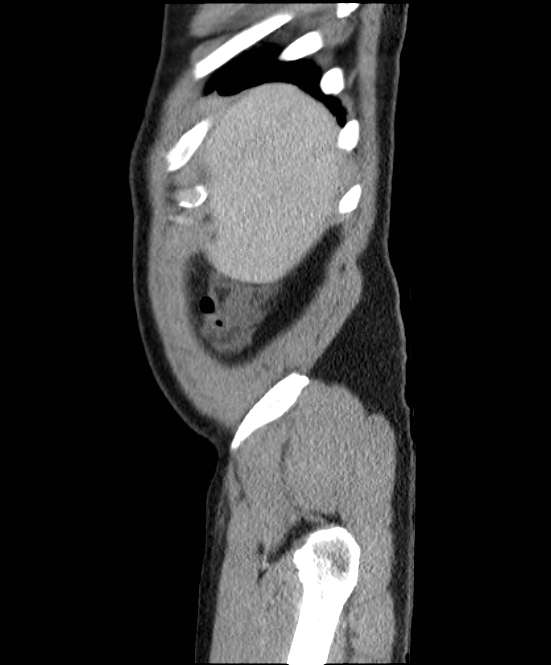 Acute pancreatitis - Balthazar E (Radiopaedia 23080-23110 Sagittal C+ portal venous phase 6).jpg