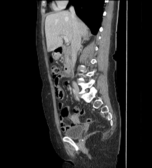 File:Acute pancreatitis - Balthazar E - post ERCP (Radiopaedia 27562-27772 Sagittal C+ portal venous phase 53).png