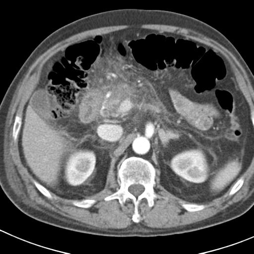 File:Acute pancreatitis and walled-off necrosis (Radiopaedia 29888-30403 Axial C+ portal venous phase 15).jpg