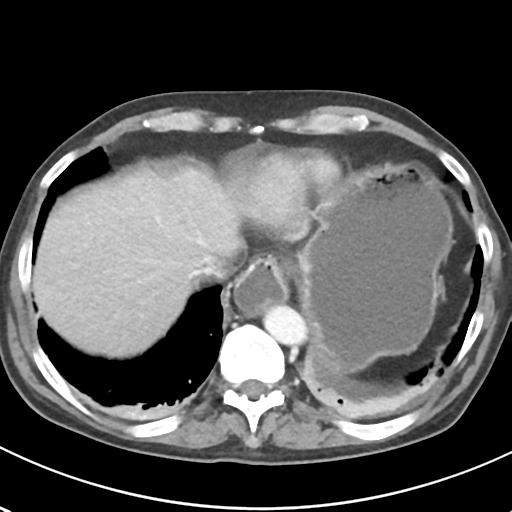 File:Acute pancreatitis and walled-off necrosis (Radiopaedia 29888-30404 Axial C+ portal venous phase 10).jpg