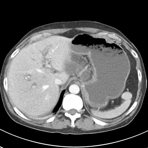 File:Acute pancreatitis and walled-off necrosis (Radiopaedia 29888-30404 Axial C+ portal venous phase 16).jpg