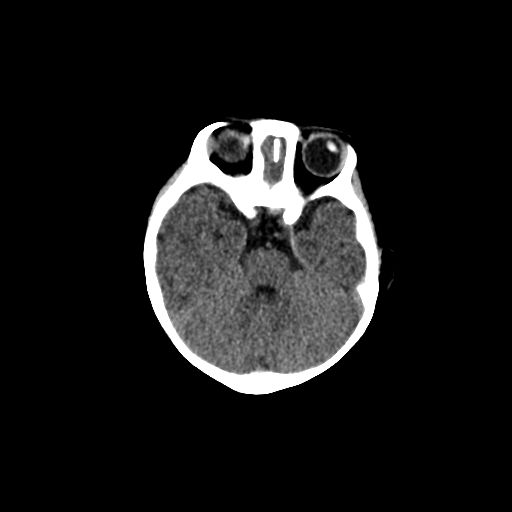 Acute phase of hemiconvulsion-hemiplegia epilepsy syndrome (Radiopaedia 29309-29744 Axial non-contrast 37).jpg