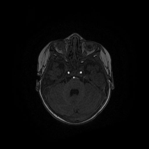 Acute phase of hemiconvulsion-hemiplegia epilepsy syndrome (Radiopaedia 29309-29745 Axial TOF angiography 108).jpg