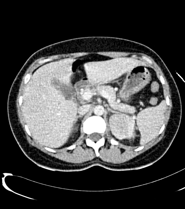 Acute pyelonephritis (Radiopaedia 40264-42816 Axial C+ portal venous phase 6).jpg