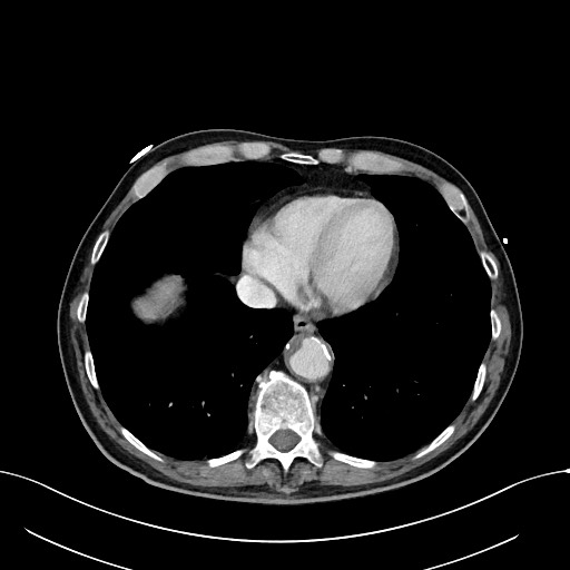 Acute renal infarction (Radiopaedia 59375-66736 Axial C+ portal venous phase 3).jpg