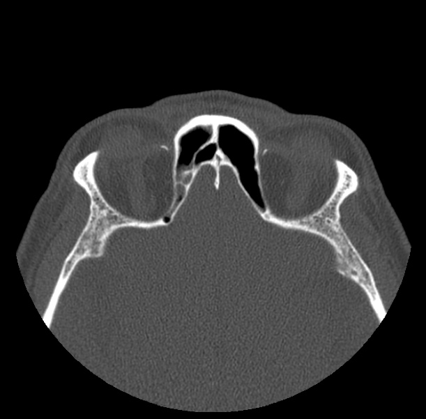 Acute sinusitis (Radiopaedia 23161-23215 Axial bone window 59).jpg