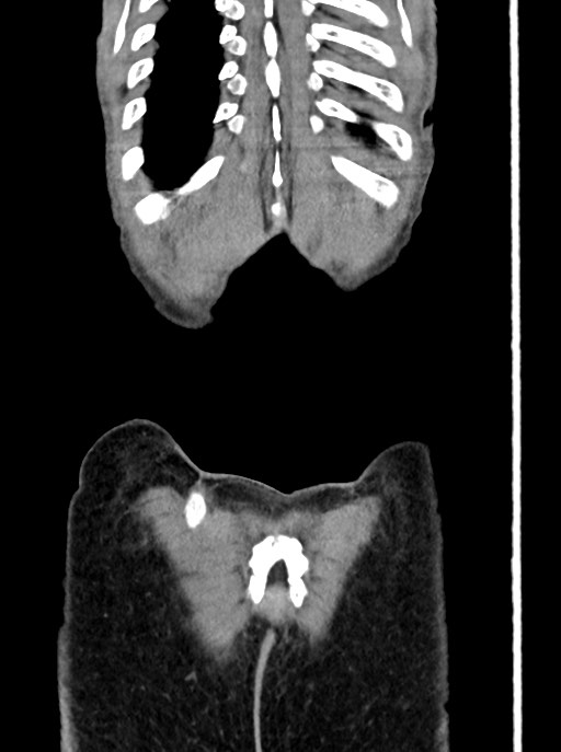 Acute small bowel (ileal) volvulus (Radiopaedia 71740-82139 Coronal C+ portal venous phase 106).jpg