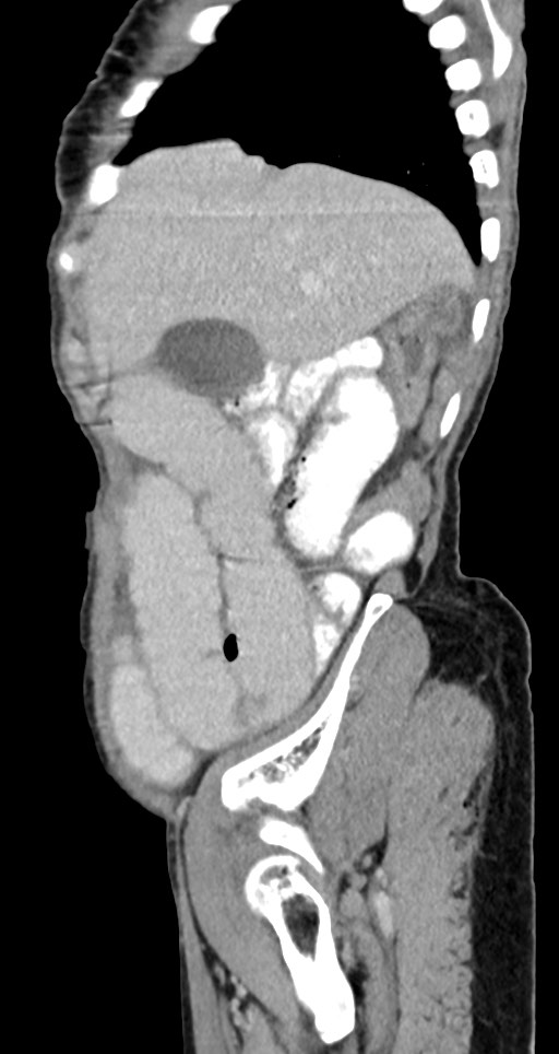 Acute small bowel (ileal) volvulus (Radiopaedia 71740-82139 Sagittal C+ portal venous phase 130).jpg