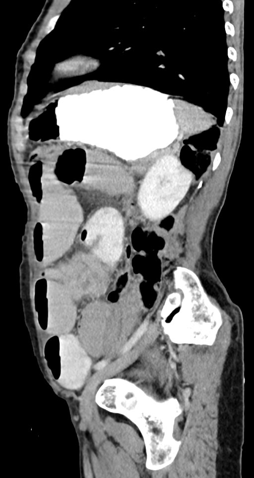 Acute small bowel (ileal) volvulus (Radiopaedia 71740-82139 Sagittal C+ portal venous phase 57).jpg