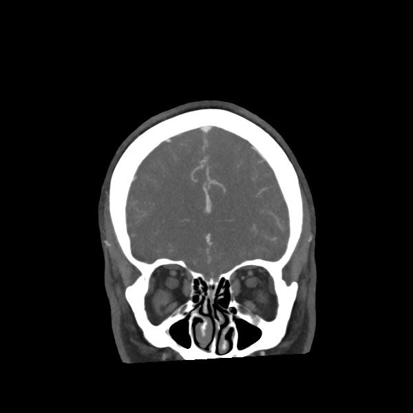 Acute subarachnoid hemorrhage and accessory anterior cerebral artery (Radiopaedia 69231-79009 Coronal C+ arterial phase 22).jpg