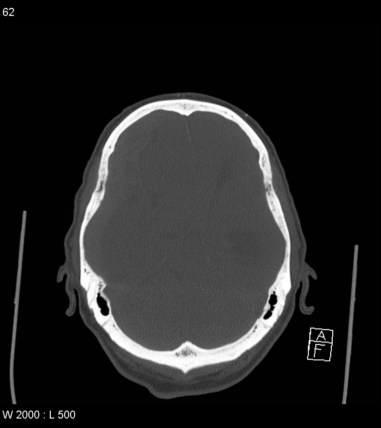 Acute subdural hematoma with myelofibrosis (Radiopaedia 52582-58494 Axial bone window 31).jpg
