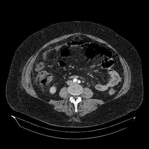 File:Acute superior mesenteric artery occlusion (Radiopaedia 51288-56960 Axial C+ arterial phase 51).jpg
