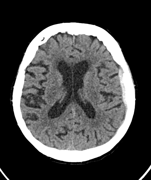 Acute traumatic subdural hematoma (Radiopaedia 82921-97257 Axial non-contrast 30).jpg