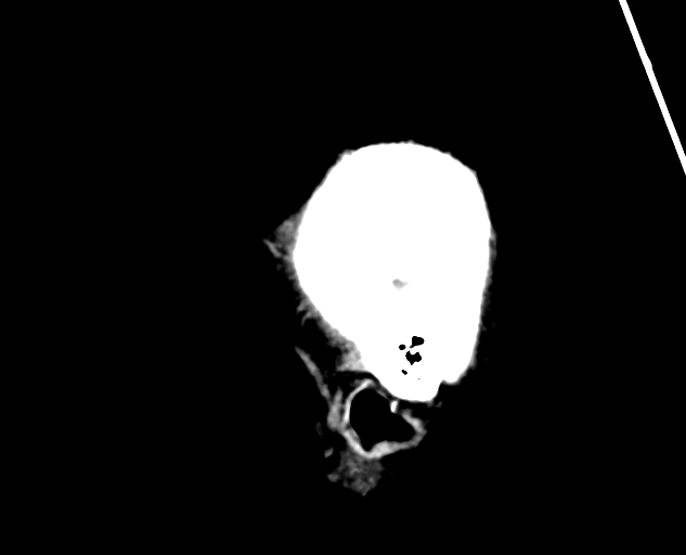 Acute traumatic subdural hematoma (Radiopaedia 82921-97257 Sagittal non-contrast 66).jpg