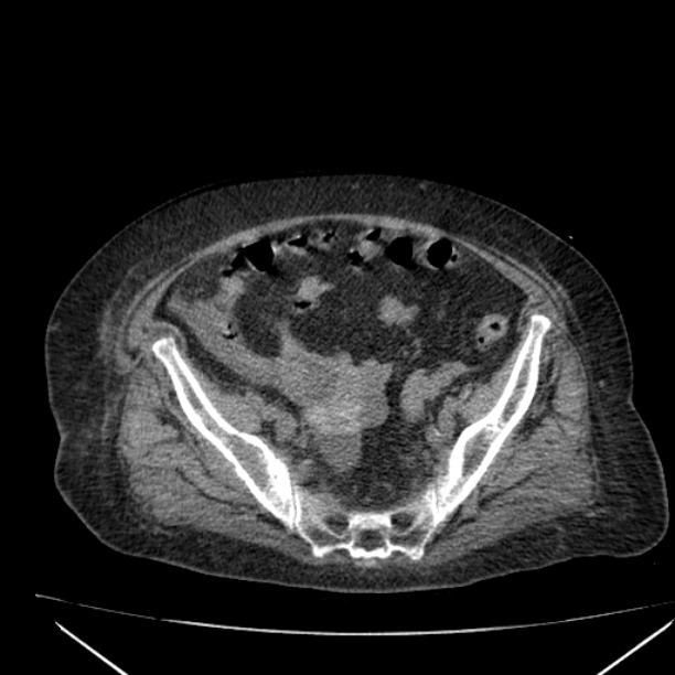 Acute tubular necrosis (Radiopaedia 28077-28334 Axial non-contrast 55).jpg