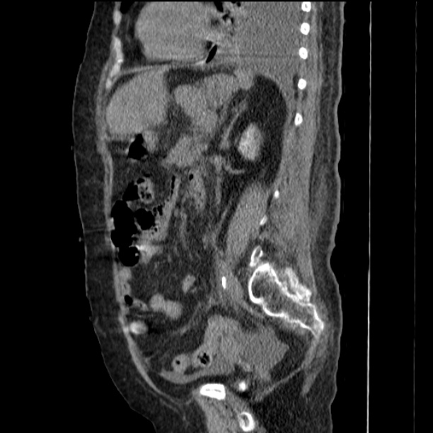 Acute tubular necrosis (Radiopaedia 28077-28334 H 56).jpg