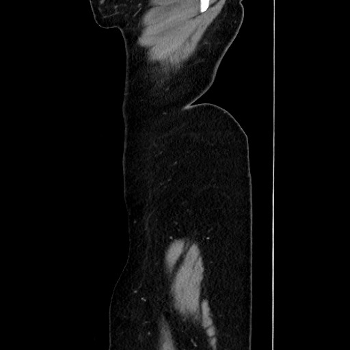 Acute uncomplicated appendicitis (Radiopaedia 73704-84499 Sagittal C+ portal venous phase 186).jpg