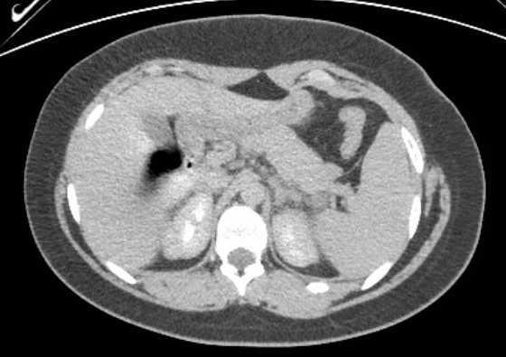 Acute unilateral nonhemorrhagic adrenal infarction (Radiopaedia 67560-76957 Axial renal excretory phase 30).jpg