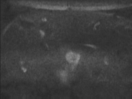Adenocarcioma of rectum- T1 lesion (Radiopaedia 36921-38546 Axial DWI 68).png