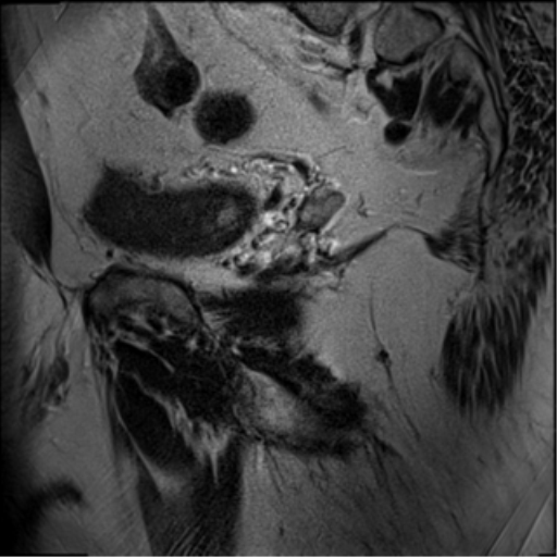 File:Adenocarcioma of rectum- T1 lesion (Radiopaedia 36921-38546 Sagittal T2 19).png