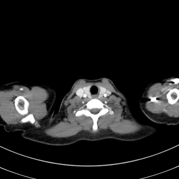 Adenocystic carcinoma of the trachea (Radiopaedia 47677-52525 Axial C+ arterial phase 25).jpg
