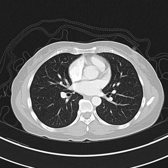 Adenocystic carcinoma of the trachea (Radiopaedia 47677-52525 Axial lung window 55).jpg