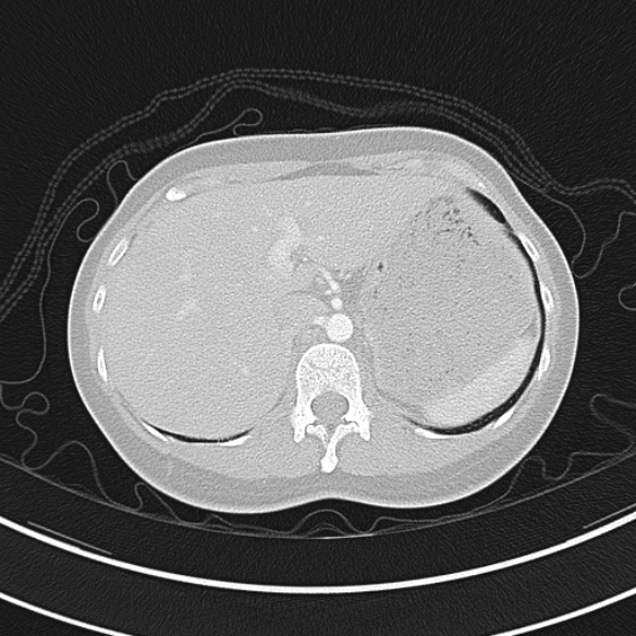 Adenocystic carcinoma of the trachea (Radiopaedia 47677-52525 Axial lung window 77).jpg