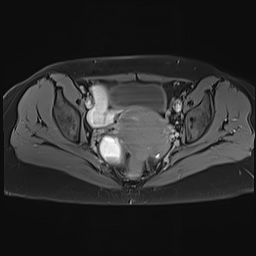 File:Adenomyosis and endometriotic cysts (Radiopaedia 82300-96367 Axial T1 C+ fat sat 12).jpg