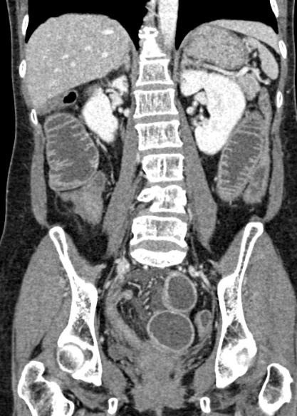 Adhesional small bowel obstruction (Radiopaedia 48397-53305 Coronal C+ portal venous phase 221).jpg