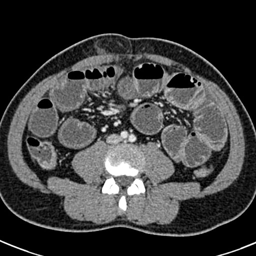 File:Adhesional small bowel obstruction (Radiopaedia 58900-66131 Axial C+ portal venous phase 30).jpg