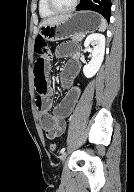 Adhesional small bowel obstruction (Radiopaedia 58900-66131 Sagittal C+ portal venous phase 168).jpg