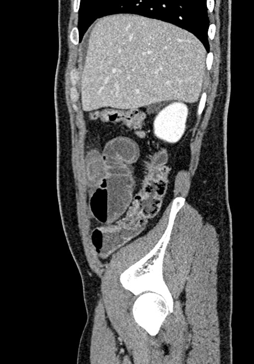 Adhesional small bowel obstruction (Radiopaedia 58900-66131 Sagittal C+ portal venous phase 53).jpg