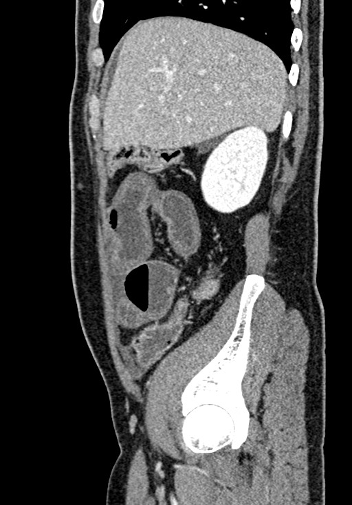 Adhesional small bowel obstruction (Radiopaedia 58900-66131 Sagittal C+ portal venous phase 62).jpg