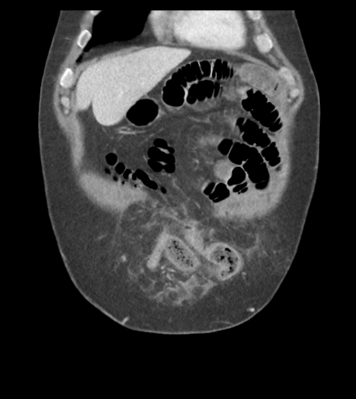 Adhesions within abdominal wall hernia (Radiopaedia 58283-65394 Coronal C+ portal venous phase 17).png