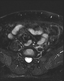 File:Adnexal multilocular cyst (O-RADS US 3- O-RADS MRI 3) (Radiopaedia 87426-103754 Axial T2 fat sat 1).jpg
