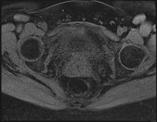 File:Adnexal multilocular cyst (O-RADS US 3. O-RADS MRI 3) (Radiopaedia 87426-103754 Axial 196).jpeg
