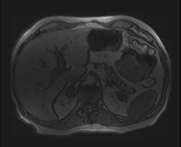 File:Adrenal adenoma (Radiopaedia 11172-42397 Axial T1 out-of-phase 1).jpg