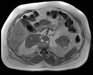 File:Adrenal cortical carcinoma (Radiopaedia 64017-72770 Axial T1 in-phase 29).jpg