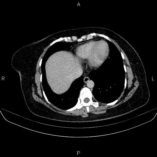 Adrenal cortical carcinoma (Radiopaedia 84882-100379 Axial C+ delayed 5).jpg