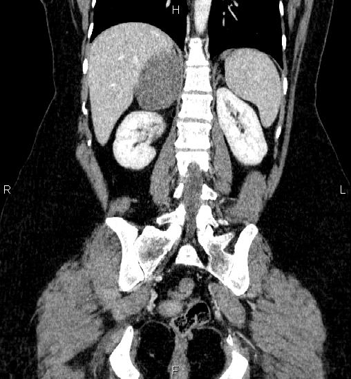 Adrenal cortical carcinoma (Radiopaedia 84882-100379 Coronal C+ portal venous phase 45).jpg