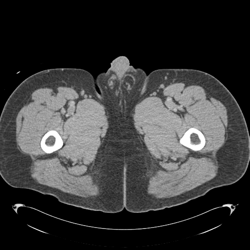 File:Adrenal cyst (Radiopaedia 45625-49776 Axial C+ portal venous phase 112).png