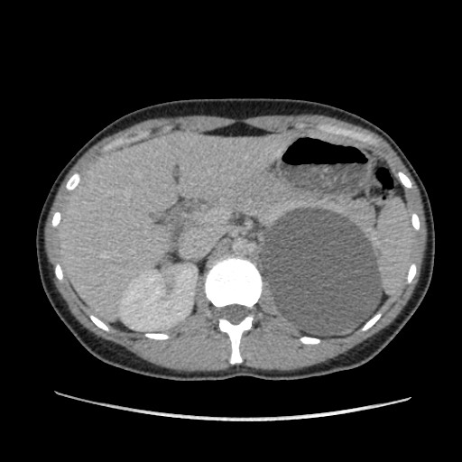 Adrenal cyst (Radiopaedia 64869-73813 Axial C+ portal venous phase 24).jpg