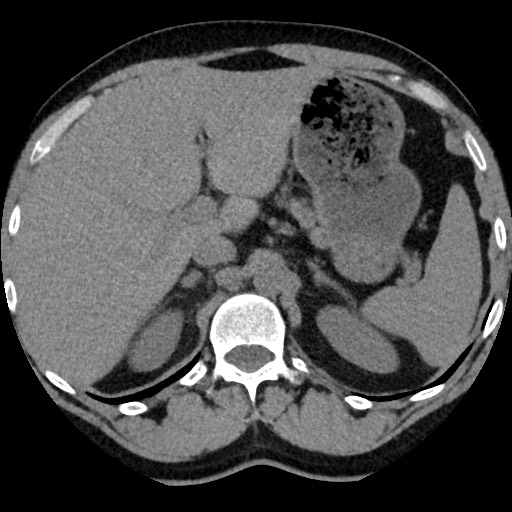 Adrenal gland trauma (Radiopaedia 81351-95079 Axial non-contrast 29).jpg