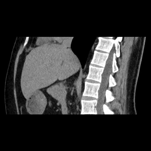 Adrenal gland trauma (Radiopaedia 81351-95079 Sagittal non-contrast 49).jpg