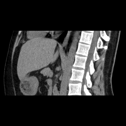 Adrenal gland trauma (Radiopaedia 81351-95079 Sagittal non-contrast 53).jpg