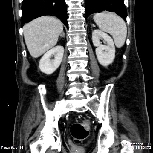 Adrenal metastasis (Radiopaedia 78425-91079 Sagittal C+ portal venous phase 48).jpg