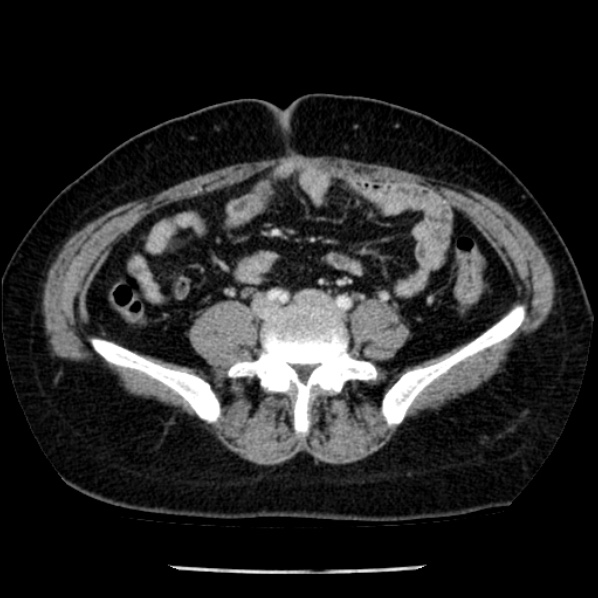 File:Adrenal myelolipoma (Radiopaedia 43401-46759 Axial C+ portal venous phase 57).jpg